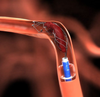 Thrombectomy