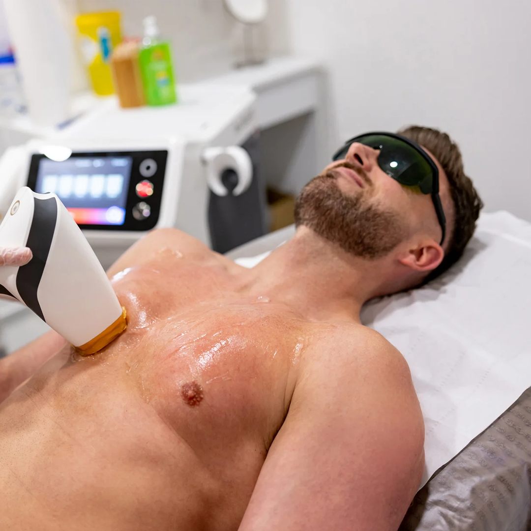 Laser Hair Removal