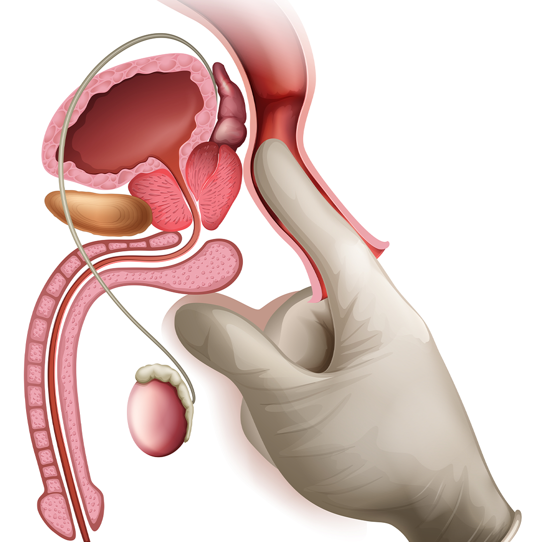 Transurethral Resection of the Prostate (TURP)