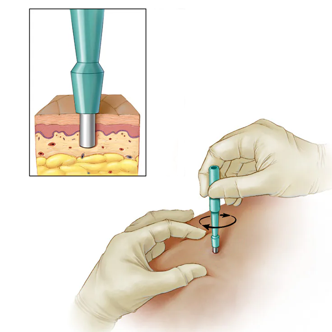 Biopsies