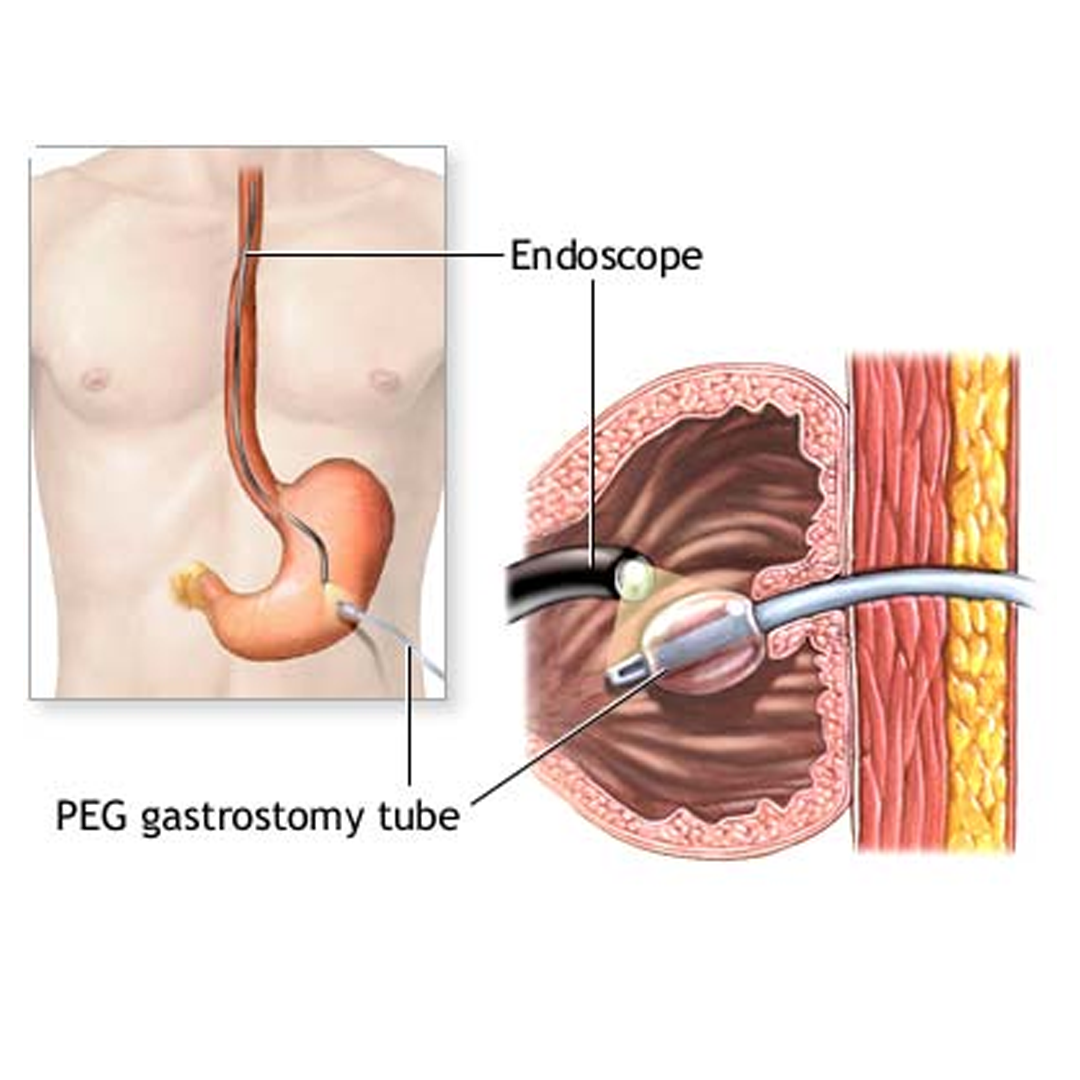 Gastrostomy Tube Placement