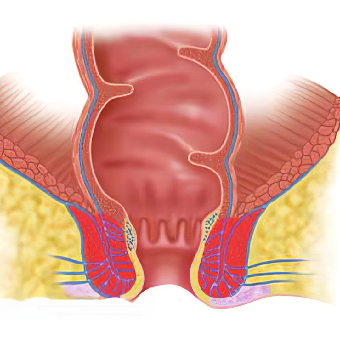 Hemorrhoidectomy