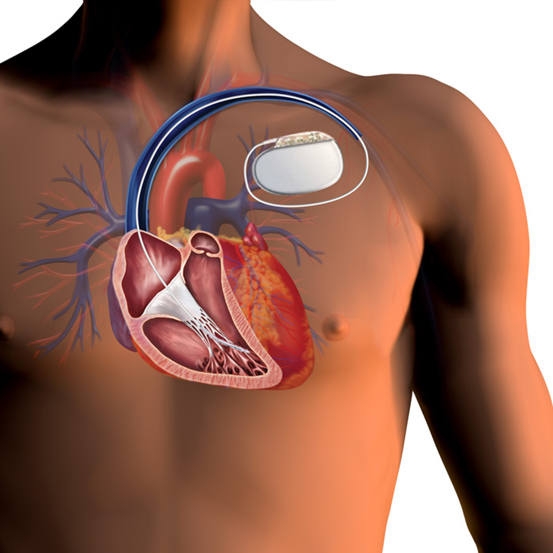 Implantable Cardioverter Defibrillators (ICDs)