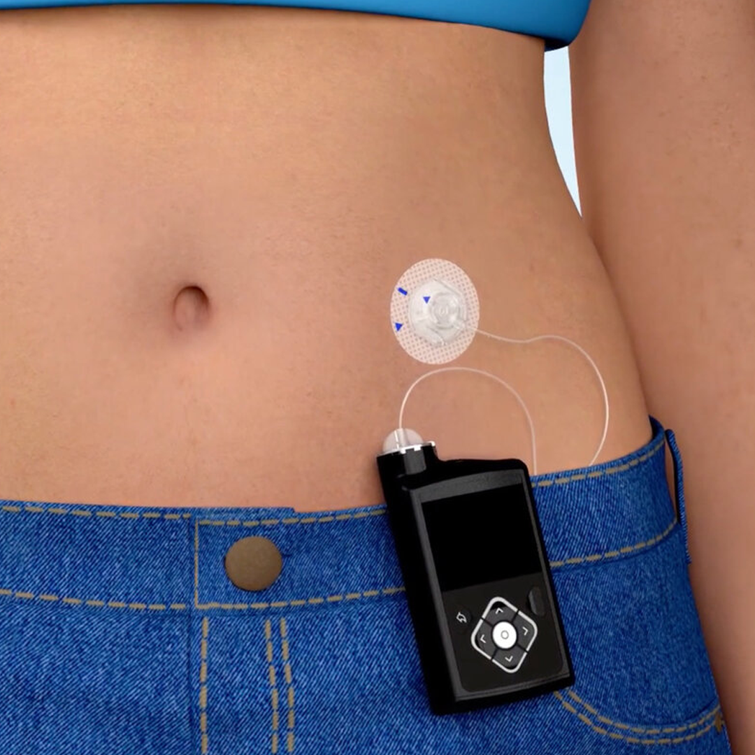 Insulin Pump Therapy