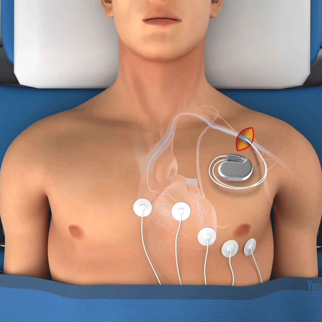 Pacemaker Implantation