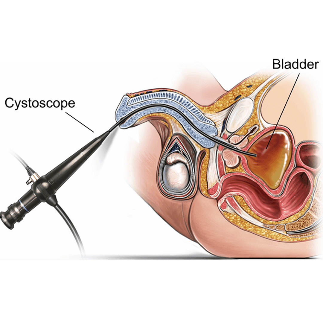 Cystoscopy