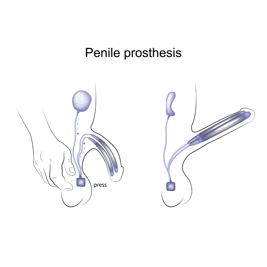 Penile Implants