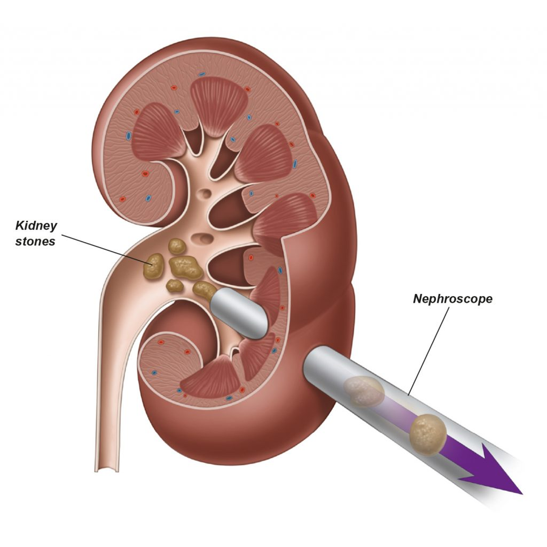 Percutaneous Nephrolithotomy (PCNL)