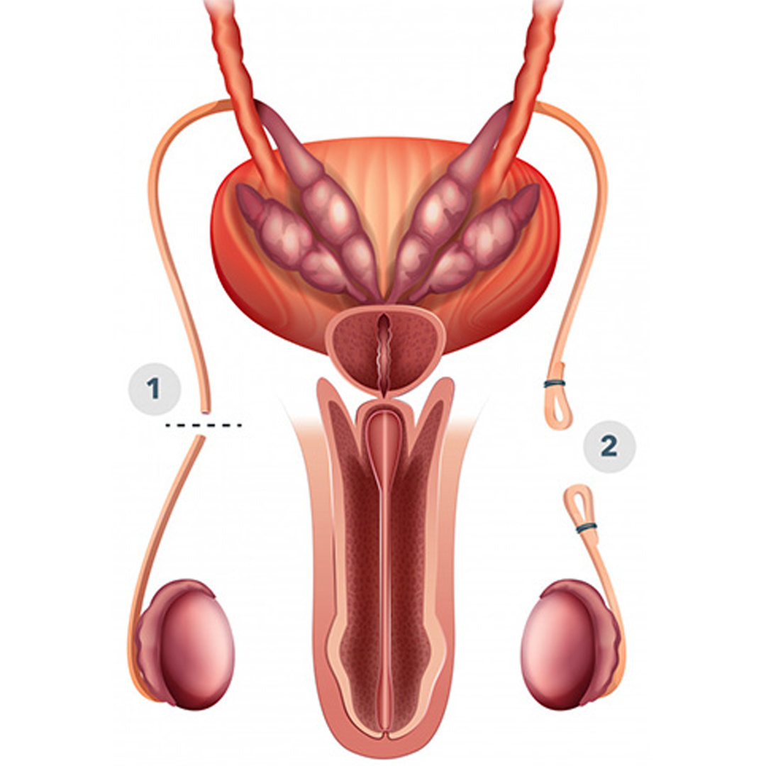 Vasectomy and Vasectomy Reversal