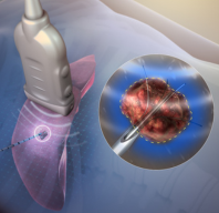 Radiofrequency Ablation (RFA)